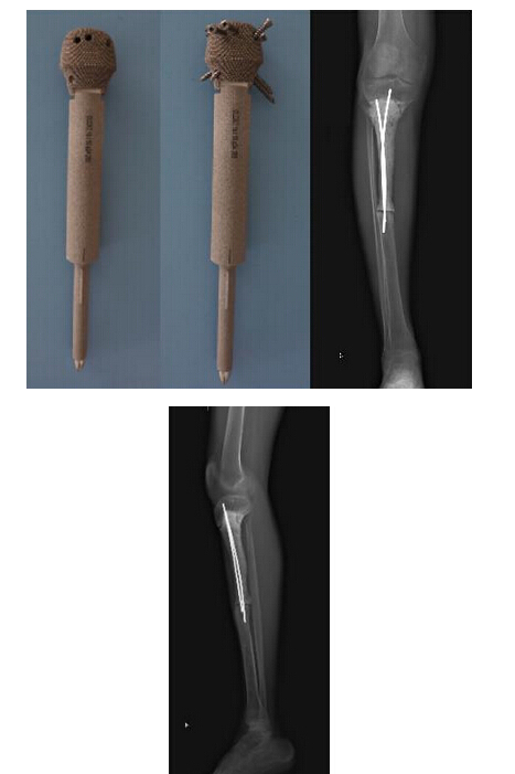 华西医院完成世界首例3D打印保留膝关节金属骨小梁假体治疗胫骨肿瘤性骨缺损