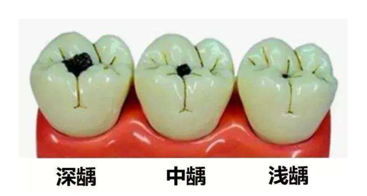 科学家开发出防蛀黑科技,可有效阻止细菌侵蚀牙釉质!